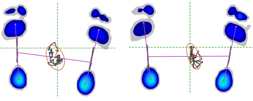 stabilometria2