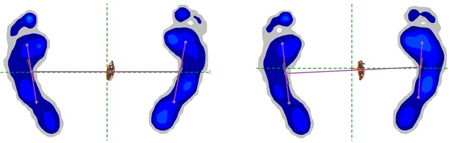 stabilometria3